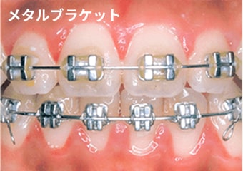 メタルブラケット