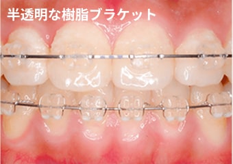樹脂ブラケット
