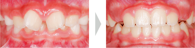 治療例 - 乳歯から永久歯に交換中