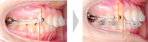 治療例① - 上顎側方歯の後方移動開始時〜3ヶ月